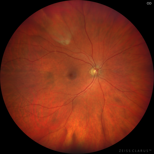 Hydroxychloroquine retinopathy - Plaquenil - Moderate - Myelinated nerve fiber layer 
51 year old female on with trouble driving at  night for a year.  No eye examination for several years. 2009 (11 years ago) Plaquenil 300 then up to 400 a few years ago now down to 300 - 5'2" 135 lbs

VA 20/20 OD, 20/25 OS
