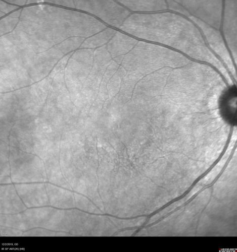 Hydroxychloroquine retinopathy - Plaquenil - Moderate
51 year old female on with trouble driving at  night for a year.  No eye examination for several years. 2009 (11 years ago) Plaquenil 300 then up to 400 a few years ago now down to 300 - 5'2" 135 lbs

VA 20/20 OD, 20/25 OS

