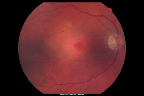 plaqueniltox_locl01.png
