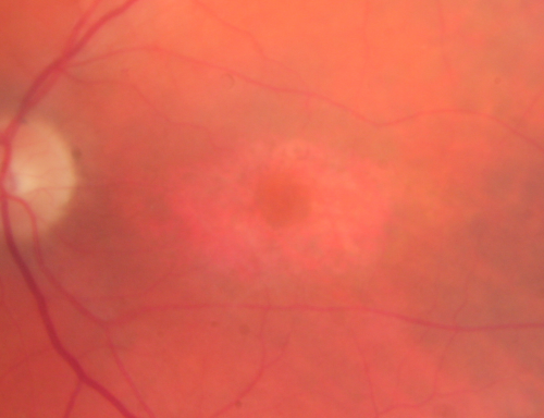 Plaquenil (Hydroxycholorquine) Toxicity - Bull's Eye Maculopathy - 73 year old womand 25 Years therapy - 64 inches tall - 110 lbs
73-year-old woman has been on Plaquenil for twenty five years.  She noticed loss of paracentral vision a few months ago. VISUAL ACUITY:  OD 20/70,  OS 20/30.   Her color vision was 0 out 10 correct in both eyes and she also missed the controls. 
