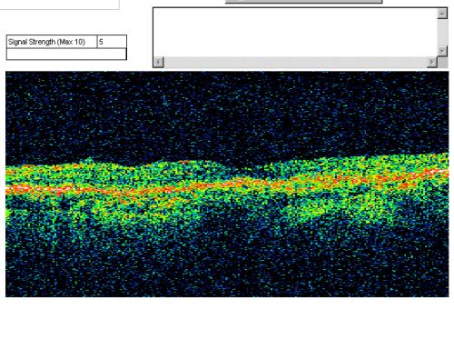 Plaquenil (Hydroxycholorquine) Toxicity - Bull's Eye Maculopathy - 73 year old womand 25 Years therapy - 64 inches tall - 110 lbs
73-year-old woman has been on Plaquenil for twenty five years.  She noticed loss of paracentral vision a few months ago. VISUAL ACUITY:  OD 20/70,  OS 20/30.   Her color vision was 0 out 10 correct in both eyes and she also missed the controls. 
