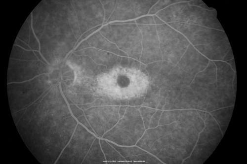 Plaquenil (Hydroxycholorquine) Toxicity - Bull's Eye Maculopathy - 73 year old womand 25 Years therapy - 64 inches tall - 110 lbs
73-year-old woman has been on Plaquenil for twenty five years.  She noticed loss of paracentral vision a few months ago. VISUAL ACUITY:  OD 20/70,  OS 20/30.   Her color vision was 0 out 10 correct in both eyes and she also missed the controls. 
