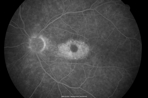 Plaquenil (Hydroxycholorquine) Toxicity - Bull's Eye Maculopathy - 73 year old womand 25 Years therapy - 64 inches tall - 110 lbs
73-year-old woman has been on Plaquenil for twenty five years.  She noticed loss of paracentral vision a few months ago. VISUAL ACUITY:  OD 20/70,  OS 20/30.   Her color vision was 0 out 10 correct in both eyes and she also missed the controls. 

