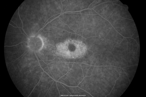 Plaquenil (Hydroxycholorquine) Toxicity - Bull's Eye Maculopathy - 73 year old womand 25 Years therapy - 64 inches tall - 110 lbs
73-year-old woman has been on Plaquenil for twenty five years.  She noticed loss of paracentral vision a few months ago. VISUAL ACUITY:  OD 20/70,  OS 20/30.   Her color vision was 0 out 10 correct in both eyes and she also missed the controls. 

