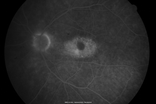 Plaquenil (Hydroxycholorquine) Toxicity - Bull's Eye Maculopathy - 73 year old womand 25 Years therapy - 64 inches tall - 110 lbs
73-year-old woman has been on Plaquenil for twenty five years.  She noticed loss of paracentral vision a few months ago. VISUAL ACUITY:  OD 20/70,  OS 20/30.   Her color vision was 0 out 10 correct in both eyes and she also missed the controls. 
