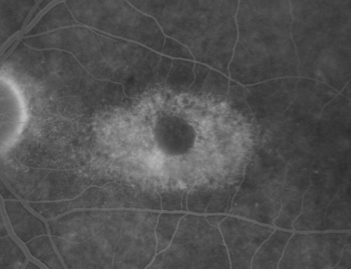 Plaquenil (Hydroxycholorquine) Toxicity - Bull's Eye Maculopathy - 73 year old womand 25 Years therapy - 64 inches tall - 110 lbs
73-year-old woman has been on Plaquenil for twenty five years.  She noticed loss of paracentral vision a few months ago. VISUAL ACUITY:  OD 20/70,  OS 20/30.   Her color vision was 0 out 10 correct in both eyes and she also missed the controls. 
