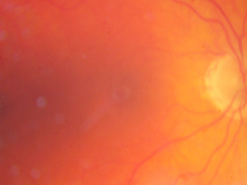 Plaquenil Toxicity both Eyes - Partial Bull's Eye - Discontinued 6 Years ago 
82-year-old woman was on Plaquenil from 1976 from 2005, 200 mg a day.  It was discontinued because of abnormal visual fields 6 years ago. OD 20/32,  OS 20/40
