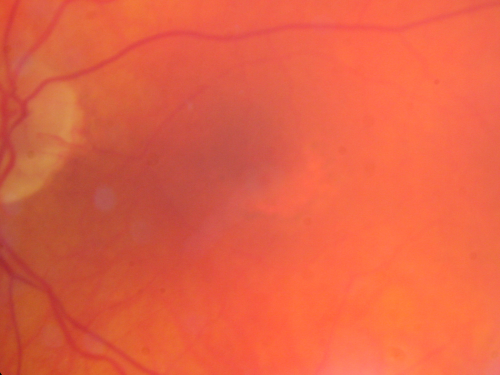 Plaquenil Toxicity both Eyes - Partial Bull's Eye - Discontinued 6 Years ago 
82-year-old woman was on Plaquenil from 1976 from 2005, 200 mg a day.  It was discontinued because of abnormal visual fields 6 years ago. OD 20/32,  OS 20/40
