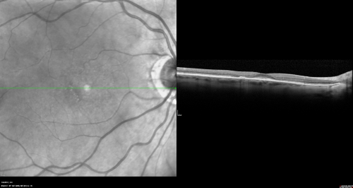 Plaquenil Toxicity both Eyes - Partial Bull's Eye - Discontinued 6 Years ago SD-OCT (Spectral domain optical coherence tomography)
82-year-old woman was on Plaquenil from 1976 from 2005, 200 mg a day.  It was discontinued because of abnormal visual fields 6 years ago. OD 20/32,  OS 20/40
