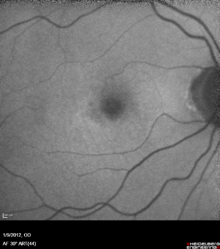 Plaquenil Toxicity both Eyes - Partial Bull's Eye - Discontinued 6 Years ago Fundus Autofluorescence
82-year-old woman was on Plaquenil from 1976 from 2005, 200 mg a day.  It was discontinued because of abnormal visual fields 6 years ago. OD 20/32,  OS 20/40
