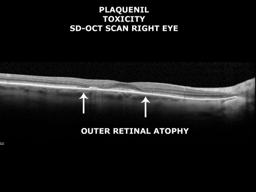 Plaquenil Toxicity both Eyes - Partial Bull's Eye - Discontinued 6 Years ago SD-OCT (Spectral domain optical coherence tomography)
82-year-old woman was on Plaquenil from 1976 from 2005, 200 mg a day.  It was discontinued because of abnormal visual fields 6 years ago. OD 20/32,  OS 20/40

