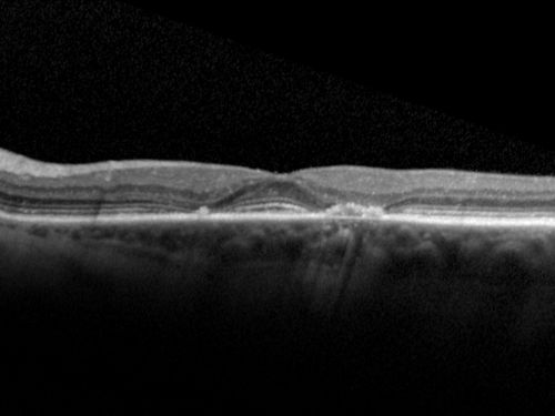 Plaquenil Toxicity both Eyes - Partial Bull's Eye - Discontinued 6 Years ago SD-OCT (Spectral domain optical coherence tomography)
82-year-old woman was on Plaquenil from 1976 from 2005, 200 mg a day.  It was discontinued because of abnormal visual fields 6 years ago. OD 20/32,  OS 20/40
