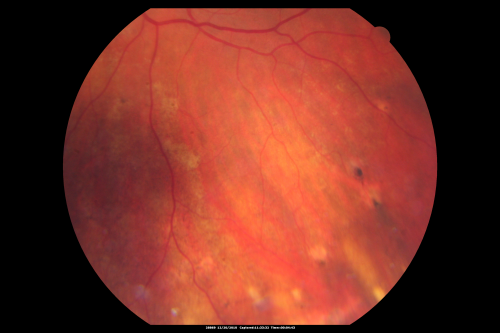 Macular Scars - Laser (1980s) Ocular Histoplasmosis
70 year old man who had laser at Wills, Wilmer and the Mayo clinic before better therapies were available for ocular histoplasmosis related CNVM
