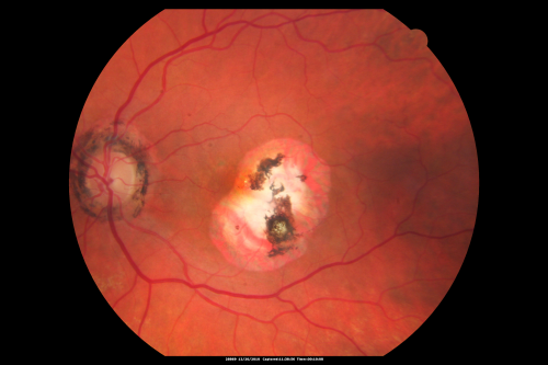 Macular Scars - Laser (1980s) Ocular Histoplasmosis
70 year old man who had laser at Wills, Wilmer and the Mayo clinic before better therapies were available for ocular histoplasmosis related CNVM
