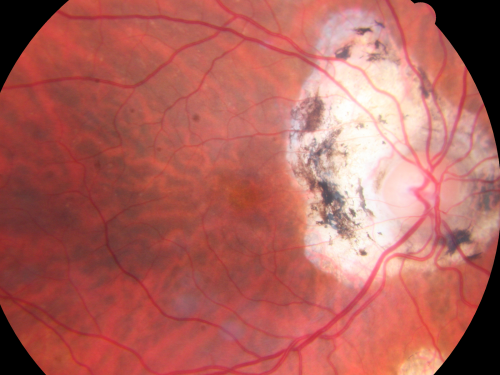 Ocular Histoplasmosis both Eyes - Laser Right Eye Only 
58-year-old woman who lost vision as a child in the left eye from ocular histoplasmosis.  She used to play in her attic and she was told by her pulmonary doctor that is probably where she picked it up.  She had laser in the right eye for a leaky lesion back in 1990.  OD 20/25,  OS 20/200. 
