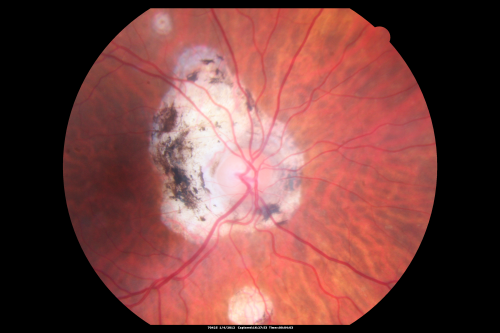 Ocular Histoplasmosis both Eyes - Laser Right Eye Only 
58-year-old woman who lost vision as a child in the left eye from ocular histoplasmosis.  She used to play in her attic and she was told by her pulmonary doctor that is probably where she picked it up.  She had laser in the right eye for a leaky lesion back in 1990.  OD 20/25,  OS 20/200. 
