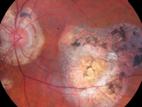 Ocular Histoplasmosis both Eyes - Laser Right Eye Only 
58-year-old woman who lost vision as a child in the left eye from ocular histoplasmosis.  She used to play in her attic and she was told by her pulmonary doctor that is probably where she picked it up.  She had laser in the right eye for a leaky lesion back in 1990.  OD 20/25,  OS 20/200. 

