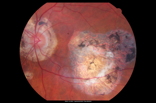 Ocular Histoplasmosis both Eyes - Laser Right Eye Only 
58-year-old woman who lost vision as a child in the left eye from ocular histoplasmosis.  She used to play in her attic and she was told by her pulmonary doctor that is probably where she picked it up.  She had laser in the right eye for a leaky lesion back in 1990.  OD 20/25,  OS 20/200. 
