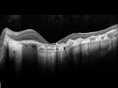 Ocular Histoplasmosis both Eyes - Laser Right Eye Only SD-OCT
58-year-old woman who lost vision as a child in the left eye from ocular histoplasmosis.  She used to play in her attic and she was told by her pulmonary doctor that is probably where she picked it up.  She had laser in the right eye for a leaky lesion back in 1990.  OD 20/25,  OS 20/200. 
