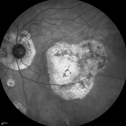Ocular Histoplasmosis both Eyes - Laser Right Eye Only InfraRed
58-year-old woman who lost vision as a child in the left eye from ocular histoplasmosis.  She used to play in her attic and she was told by her pulmonary doctor that is probably where she picked it up.  She had laser in the right eye for a leaky lesion back in 1990.  OD 20/25,  OS 20/200. 

