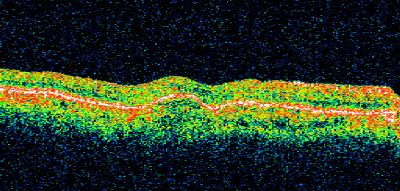 Wet AMD - Subfoveal CNVM - Excellent Response to Avastin
76-year-old woman two to three months of vision loss OD

Vision started at 20/200 and with Avastin improved to 20/25.  She has required monthly injections and as of October 2010 has been treated about 16 times.  Her left eye remains good at 20/20. 

The OCT from post-treatment as well as pretreatment images are in this album.
