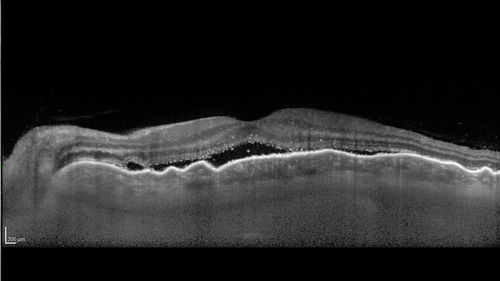Posterior Scleritis - positive T-sign
62 year ols man was sick about 6 weeks ago and then 2 weeks ago the the left eye got red.  He was treated for conjunctivitis and the eye did not get better.  Topical steroids and oral non-steroidal anti-inflammatory medications did not help.  
VA OD: Dcc20/25 NccJ5
VA OS: Dcc5'/200 
The scleritis cleared within 2 weeks of starting high dose (80 mg) oral steroids.  Blood tests were all negative.
