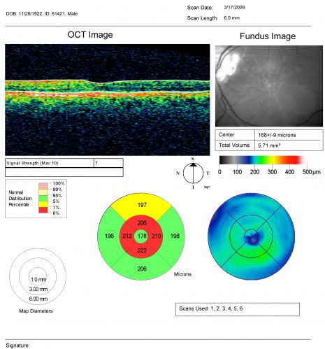 Juxtapapillary CNVM and Serous Macular Detachment Wet AMD Rx Laser
85-year-old man OD is 20/25, OS is 20/100.  IOP:  OD 21, OS 22.  

OS:   Vertical C/D ratio is 0.1.  There is a posterior vitreous separation.  There is a hemorrhagic pigment epithelial detachment on the superior pole of the optic nerve, extending a disc-and-a-half diameter off the nerve, with adjacent exudates.  There is a serous macular detachment involving the center of the fovea.  

VA improved from 20/100 to 20/50 in four months from laser.
Mots-clés: wet; juxtapapillary;laser;amd;serous;detachment