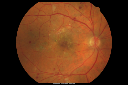 BDR and Diabetic Macular Edema with Fresh Laser Right Eye
60-year old man OD 20/60, OS 20/50 worsening vision both eyes
