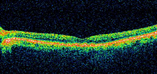 Juxtapapillary CNVM and Serous Macular Detachment Wet AMD Rx Laser
85-year-old man OD is 20/25, OS is 20/100.  IOP:  OD 21, OS 22.  

OS:   Vertical C/D ratio is 0.1.  There is a posterior vitreous separation.  There is a hemorrhagic pigment epithelial detachment on the superior pole of the optic nerve, extending a disc-and-a-half diameter off the nerve, with adjacent exudates.  There is a serous macular detachment involving the center of the fovea.  

VA improved from 20/100 to 20/50 in four months from laser.
Keywords: wet; juxtapapillary;laser;amd;serous;detachment