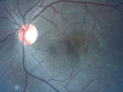 Retinal Detachment with Subretinal Fibrosis - Chronic with new Foveal Involvement 25 Year Old - POST OP
25-year-old man vision loss in the left eye for a month.  He noticed a shadow up above, which went through his central vision.  He has not had any injuries in the left eye.  
VISUAL ACUITY:  Vision OD is 20/20, OS is 20/400

Post Op photo vision still 20/400
