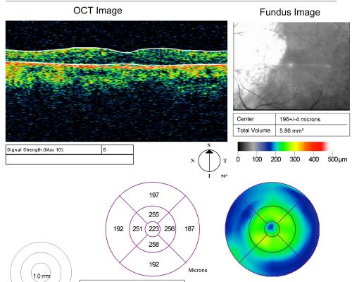 Acute Zonal Occult Outer Retinopathy with Severe Peripheral Vision Loss Left Eye  Post Treatment for CME
 58-year-old man developed a peripheral vision problem about 25 years ago.   OD 20/30, OS 20/40.
Schlüsselwörter: azoor;bone spicules;retinitis pigmentosa;rp;pseudo