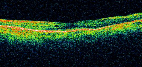 Acute Zonal Occult Outer Retinopathy with Severe Peripheral Vision Loss Left Eye Post Treatment for CME
 58-year-old man developed a peripheral vision problem about 25 years ago.   OD 20/30, OS 20/40.
Keywords: azoor;bone spicules;retinitis pigmentosa;rp;pseudo