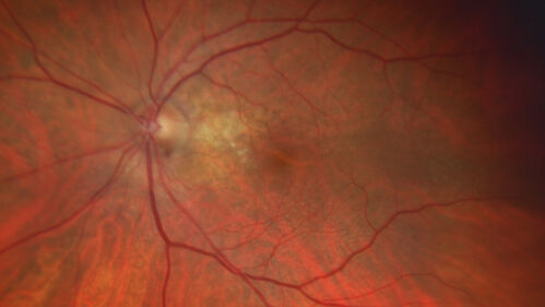 Peripapillary CNVM No Treatment
85 year old with peripapillary CNVM watched for many years.
