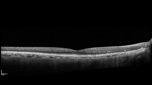 Peripapillary CNVM No Treatment
85 year old with peripapillary CNVM watched for many years.
