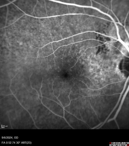 Peripapillary CNVM No Treatment
85 year old with peripapillary CNVM watched for many years.

