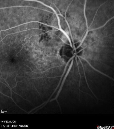 Peripapillary CNVM No Treatment
85 year old with peripapillary CNVM watched for many years.
