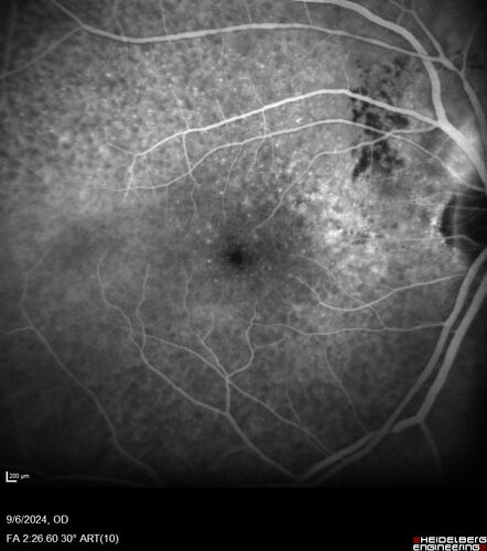 Peripapillary CNVM No Treatment
85 year old with peripapillary CNVM watched for many years.
