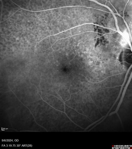 Peripapillary CNVM No Treatment
85 year old with peripapillary CNVM watched for many years.
