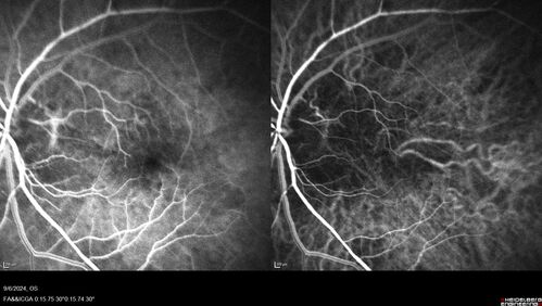 Peripapillary CNVM No Treatment
85 year old with peripapillary CNVM watched for many years.
