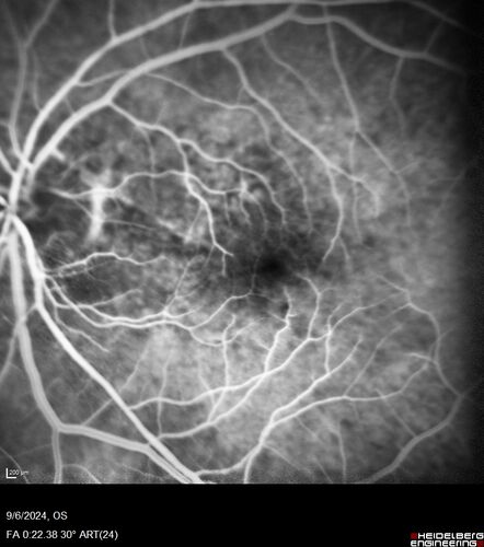 Peripapillary CNVM No Treatment
85 year old with peripapillary CNVM watched for many years.
