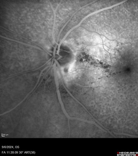 Peripapillary CNVM No Treatment
85 year old with peripapillary CNVM watched for many years.
