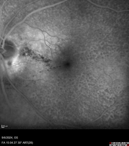 Peripapillary CNVM No Treatment
85 year old with peripapillary CNVM watched for many years.
