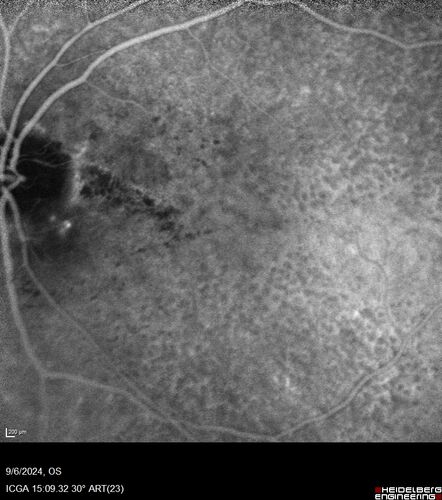 Peripapillary CNVM No Treatment
85 year old with peripapillary CNVM watched for many years.
