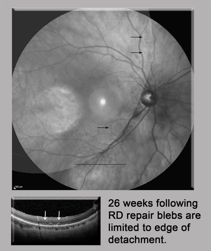 Persistent subfoveal fluid - Infrared Reflectance
