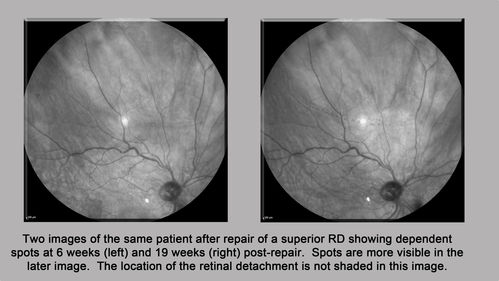 Persistent subfoveal fluid - Infrared Reflectance
