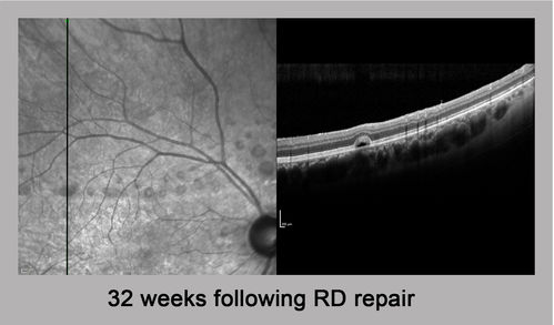 Persistent subfoveal fluid - Infrared Reflectance
