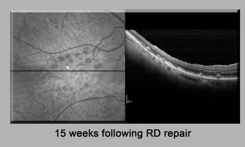 Persistent subfoveal fluid - Infrared Reflectance
