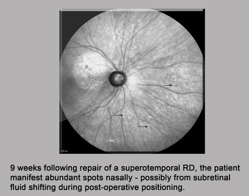 Persistent subfoveal fluid - Infrared Reflectance
