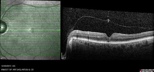Prefoveal Opercula and early Lamellar Macular Hole
73 year old man with 20/32 vision and pre-foveal opercula.  The OCT shows very early lamellar hole with lamellar hole epiretinal proliferation
