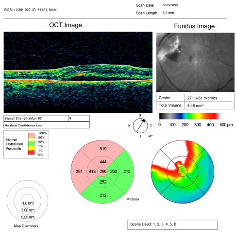 Juxtapapillary CNVM and Serous Macular Detachment Wet AMD Rx Laser
85-year-old man OD is 20/25, OS is 20/100.  IOP:  OD 21, OS 22.  

OS:   Vertical C/D ratio is 0.1.  There is a posterior vitreous separation.  There is a hemorrhagic pigment epithelial detachment on the superior pole of the optic nerve, extending a disc-and-a-half diameter off the nerve, with adjacent exudates.  There is a serous macular detachment involving the center of the fovea.  

VA improved from 20/100 to 20/50 in four months from laser.
Keywords: wet; juxtapapillary;laser;amd;serous;detachment